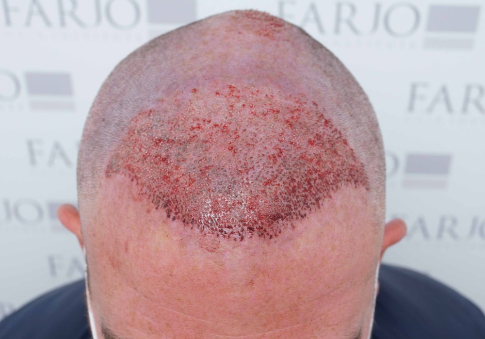 Dr Farjo hair transplant 14.jpg