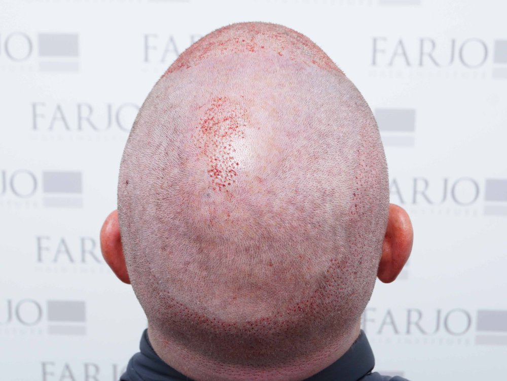 Dr Farjo hair transplant 15.jpg