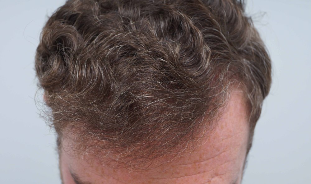 Dr Farjo hair transplant 2.jpg