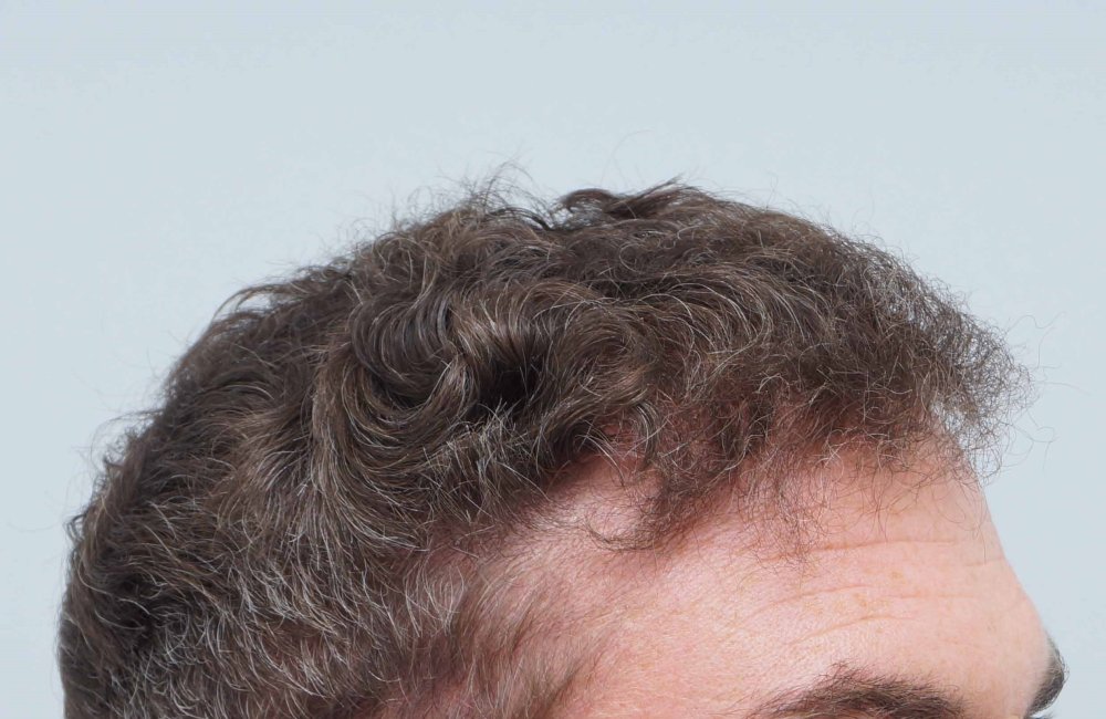 Dr Farjo hair transplant 3.jpg