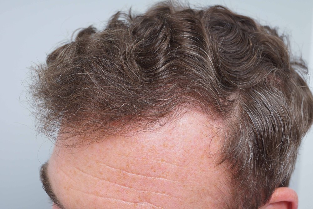 Dr Farjo hair transplant 4.jpg