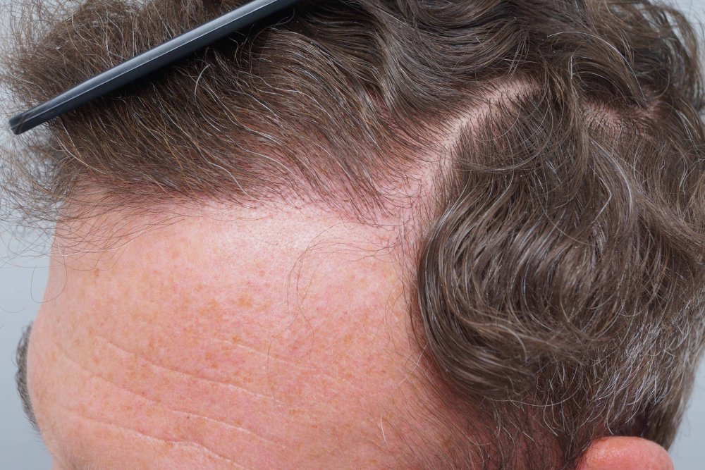 Dr Farjo hair transplant 5.jpg