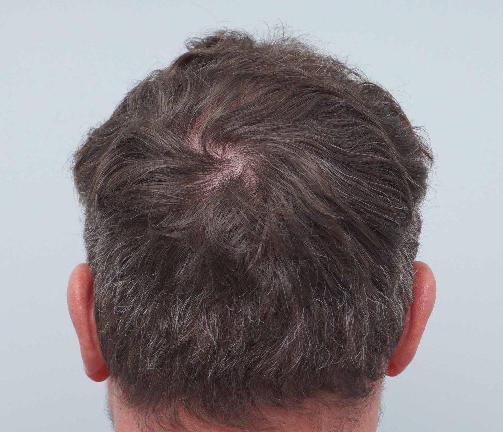Dr Farjo hair transplant 6.jpg