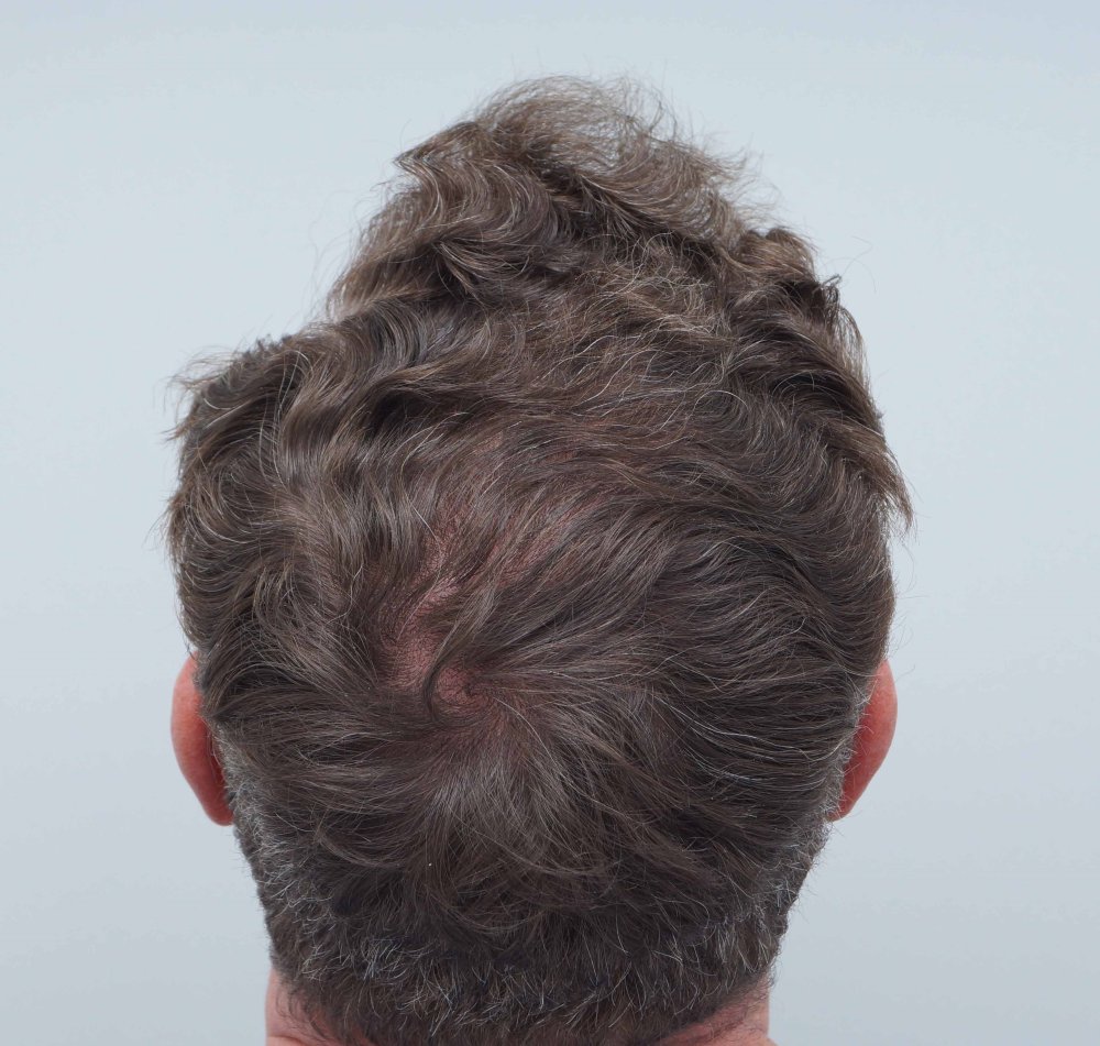 Dr Farjo hair transplant 7.jpg