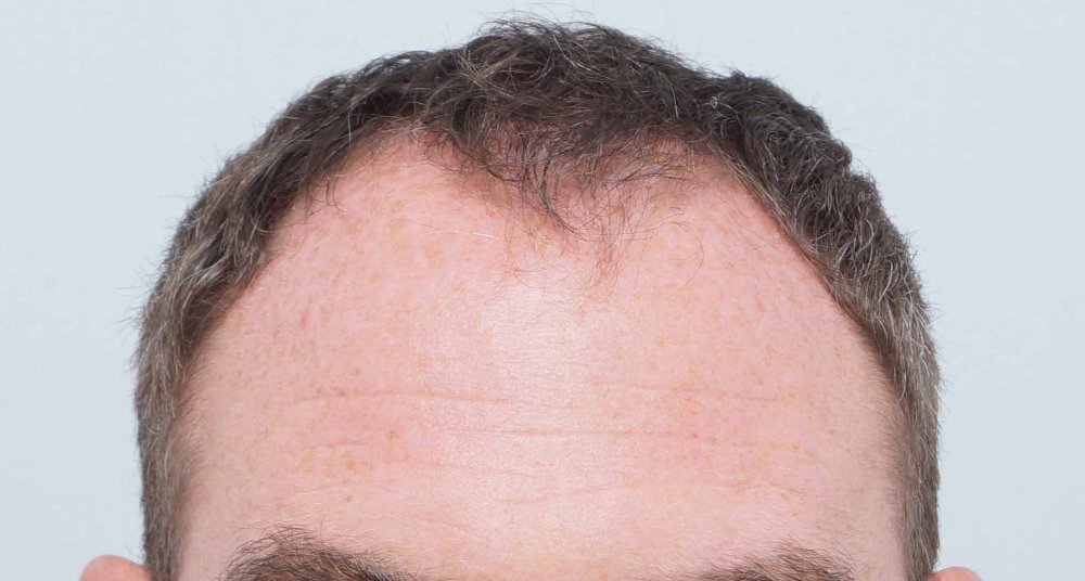 Dr Farjo hair transplant 8.jpg