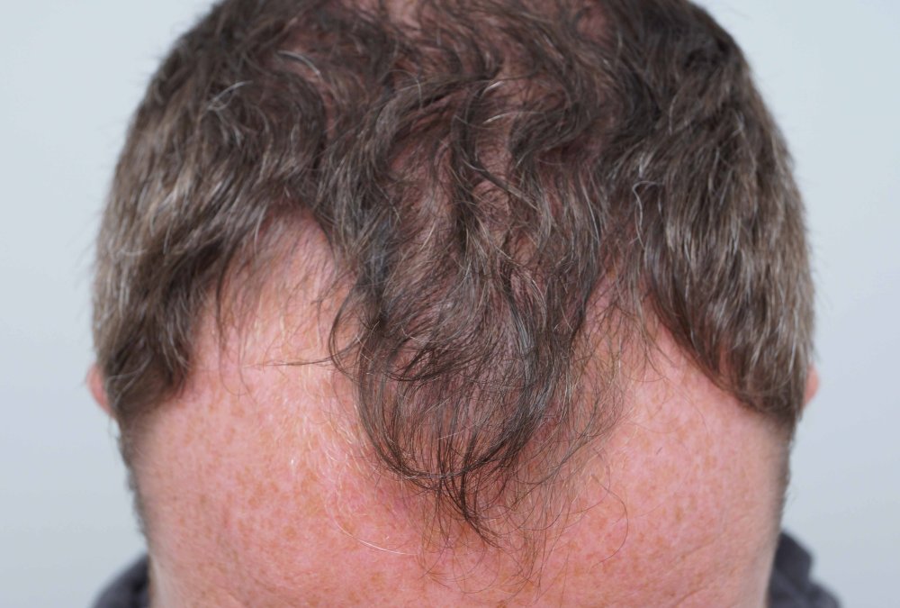 Dr Farjo hair transplant 9.jpg