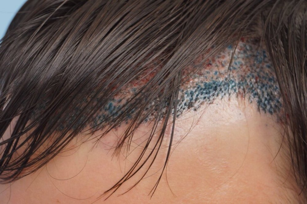 Dr Farjo hair transplant1.jpg