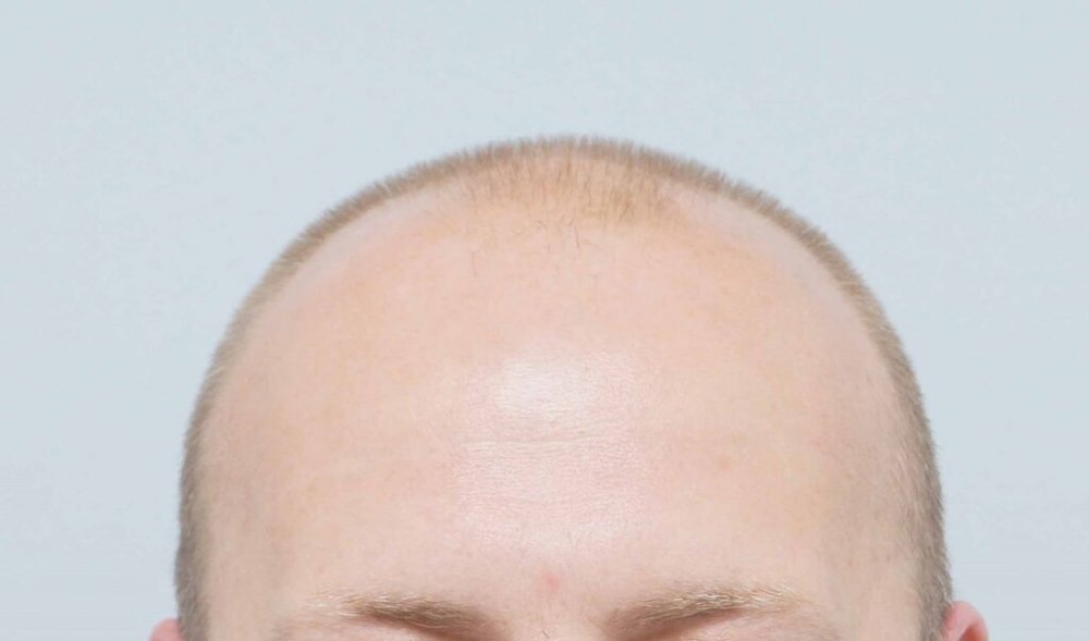 Dr Farjo Hair Transplant1.jpg
