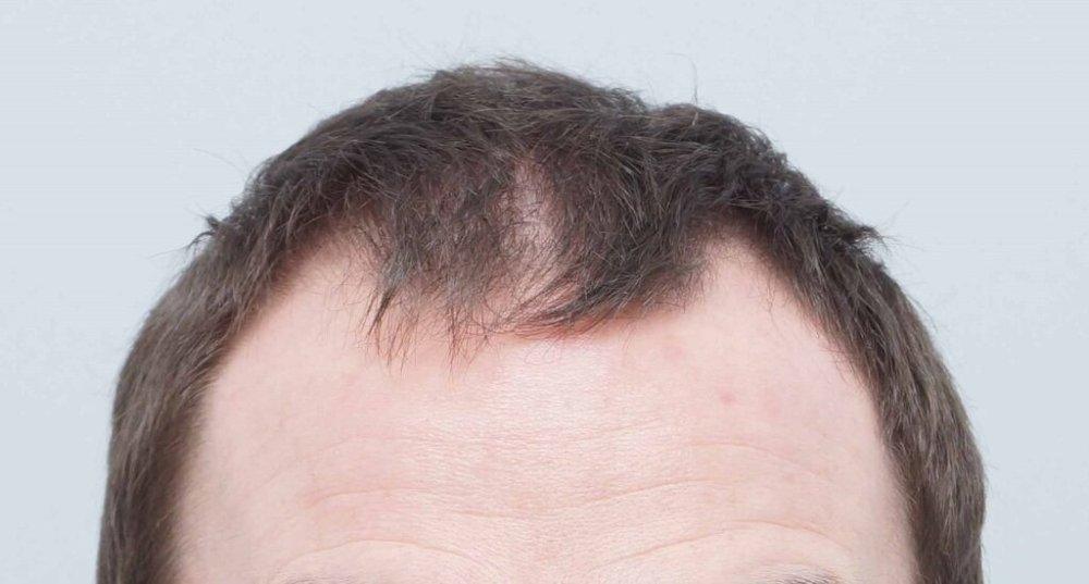 Dr Farjo hair transplant1.jpg