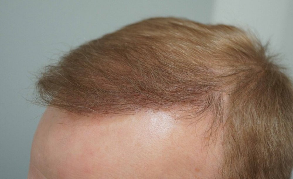 Dr Farjo Hair Transplant11.jpg