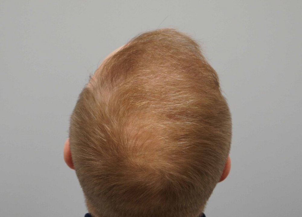 Dr Farjo Hair Transplant12.jpg