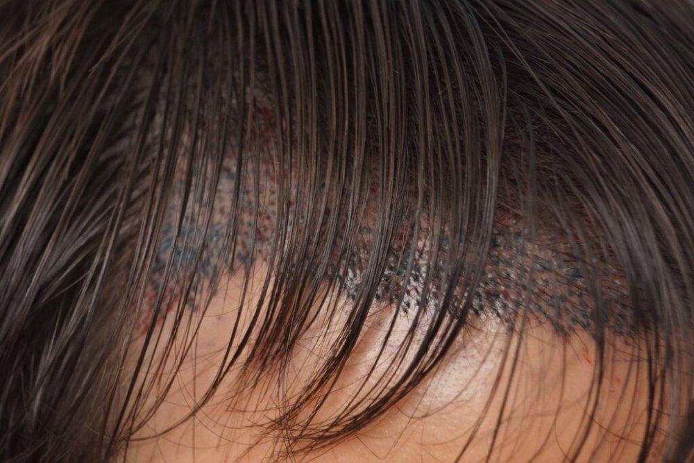 Dr Farjo hair transplant2.jpg