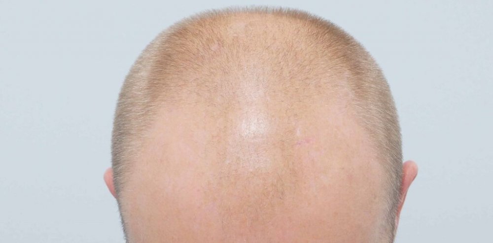 Dr Farjo Hair Transplant2.jpg