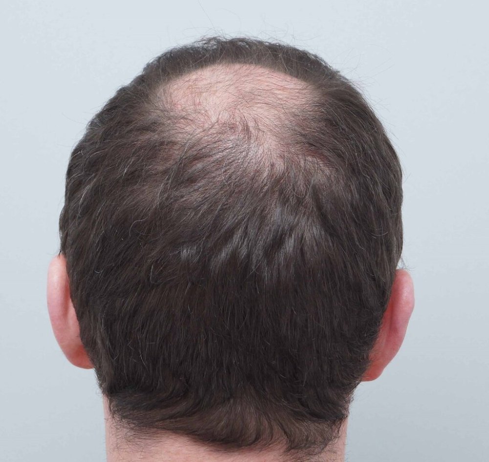 Dr Farjo hair transplant2.jpg