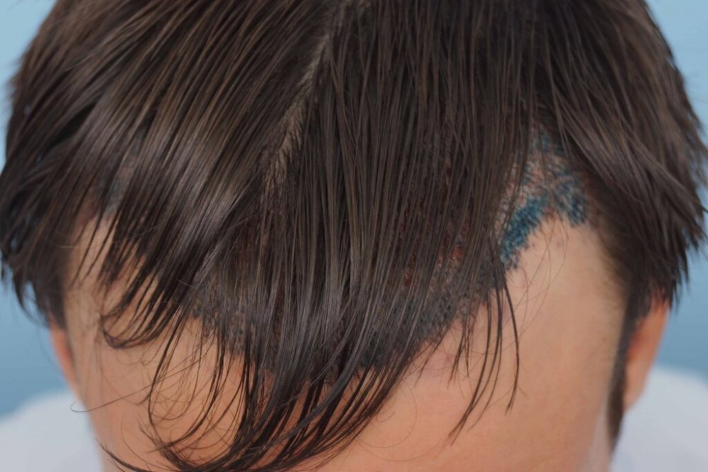 Dr Farjo hair transplant3.jpg