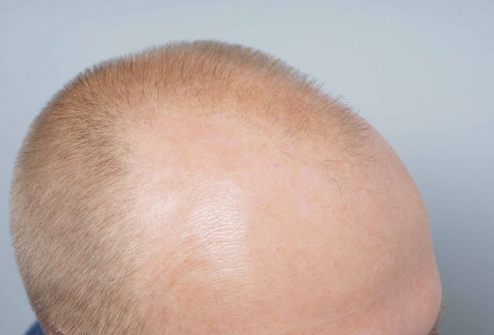 Dr Farjo Hair Transplant3.jpg