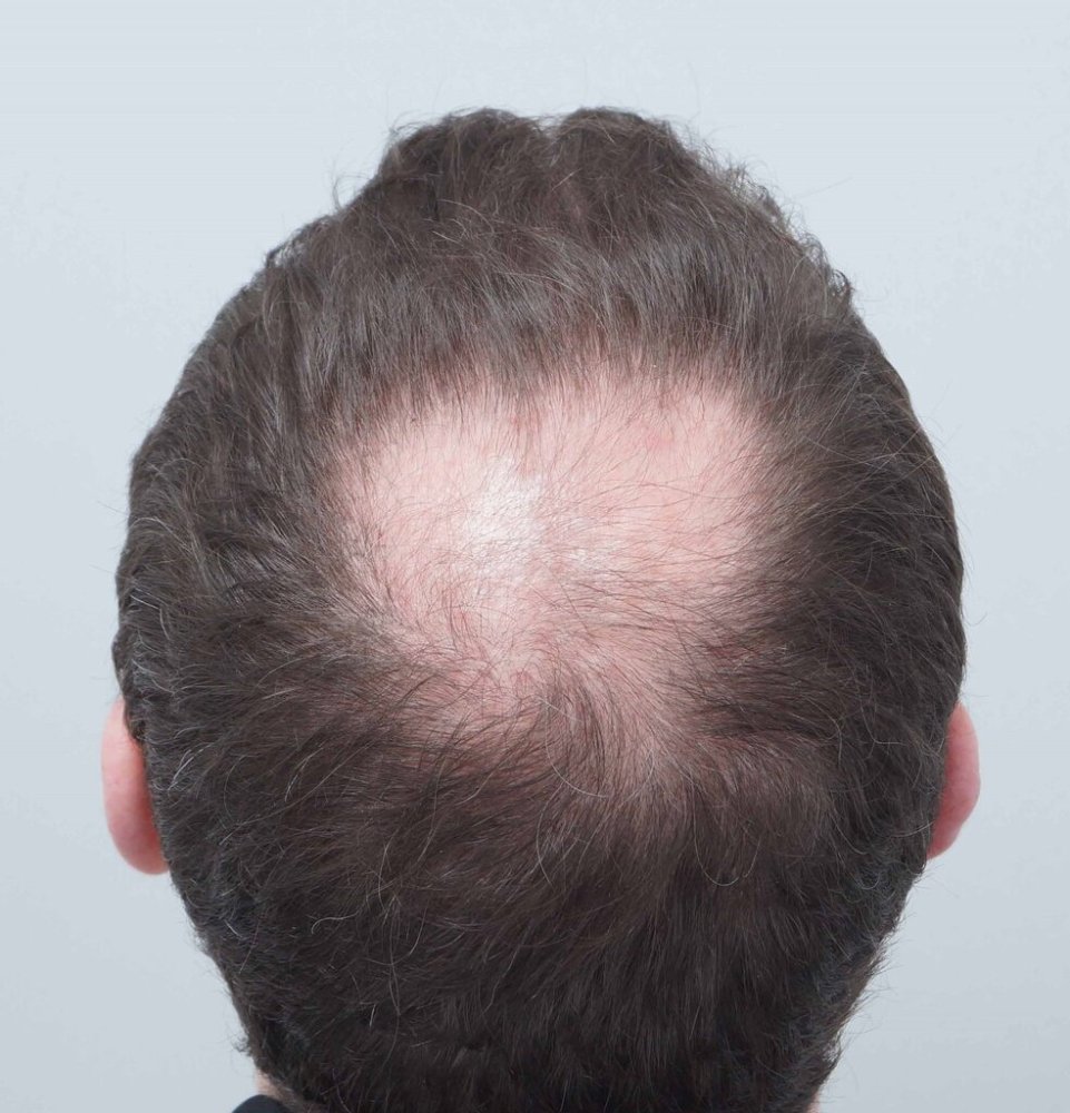 Dr Farjo hair transplant3.jpg