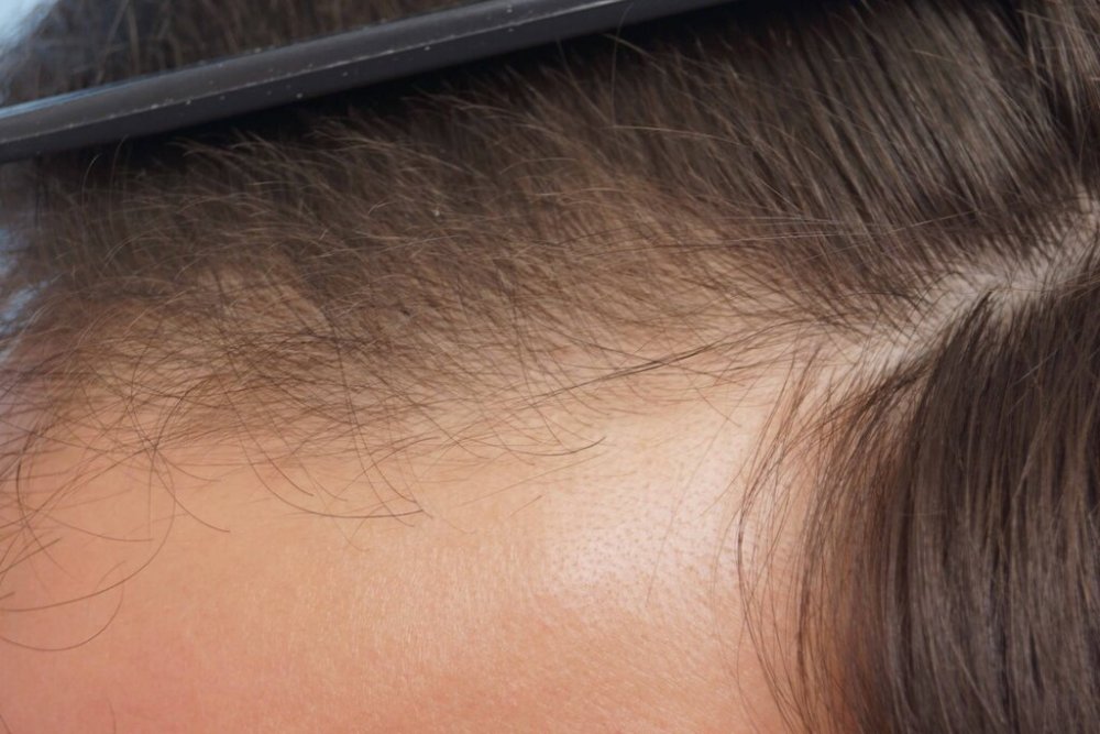 Dr Farjo hair transplant4.jpg