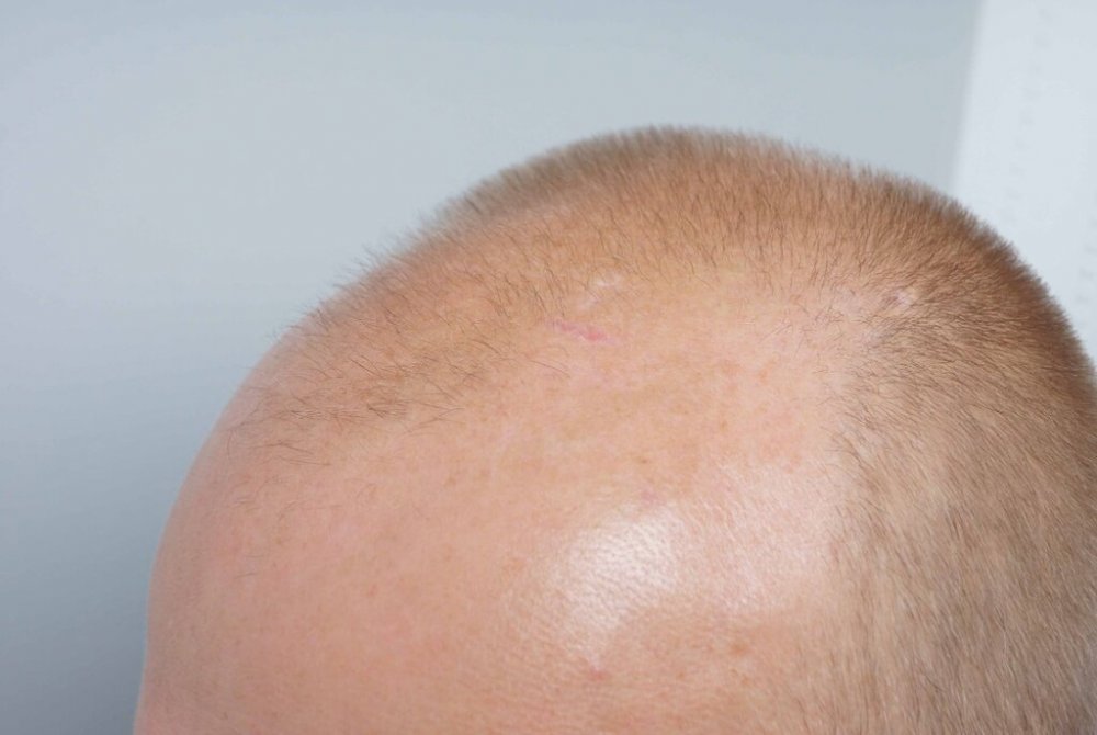 Dr Farjo Hair Transplant4.jpg