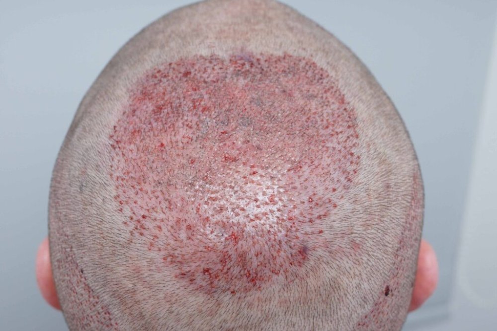 Dr Farjo hair transplant4.jpg