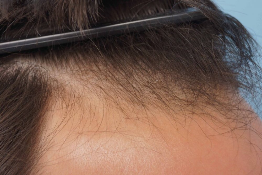 Dr Farjo hair transplant5.jpg