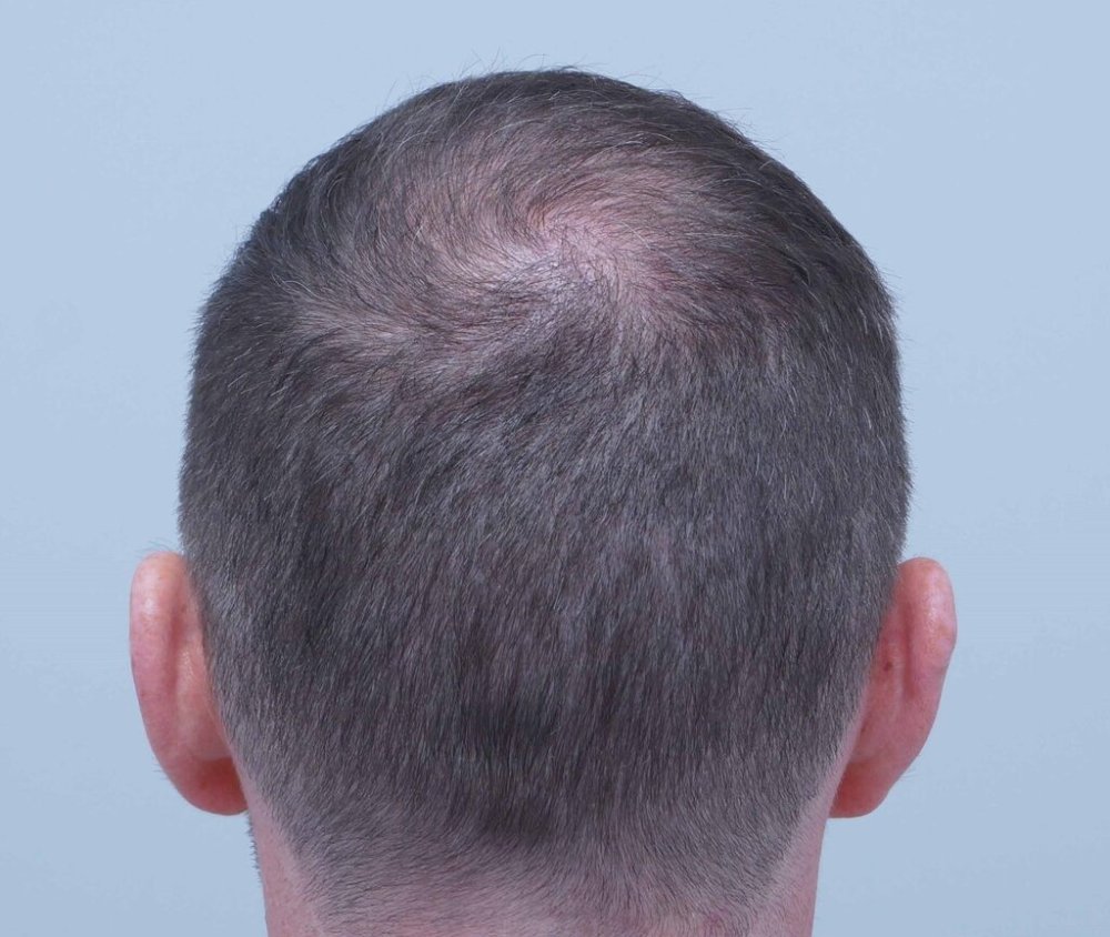 Dr Farjo hair transplant5.jpg