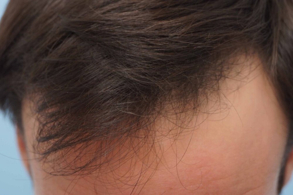 Dr Farjo hair transplant6.jpg