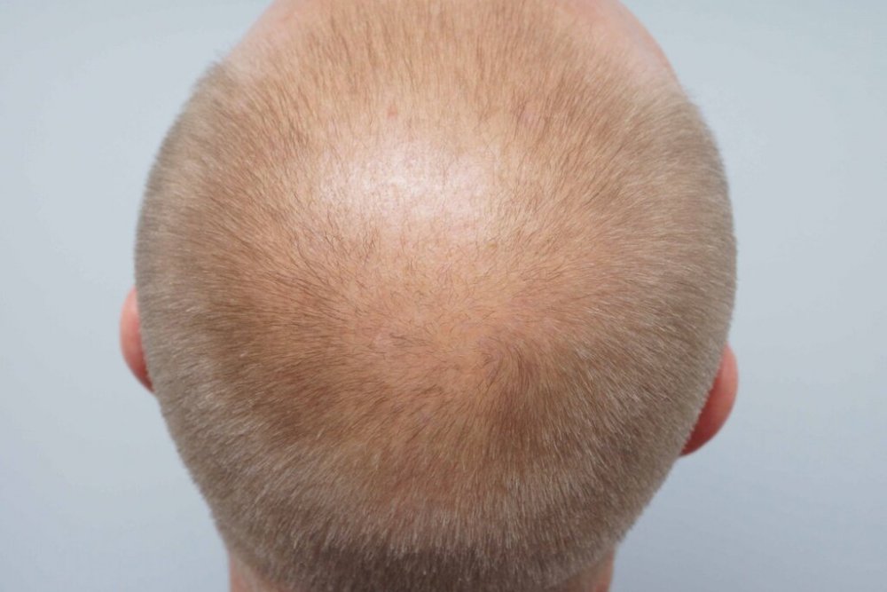 Dr Farjo Hair Transplant6.jpg