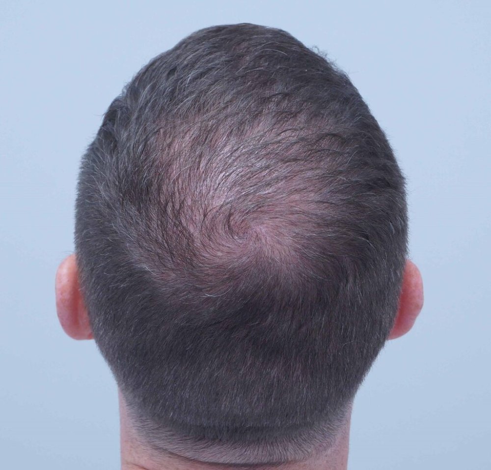 Dr Farjo hair transplant6.jpg