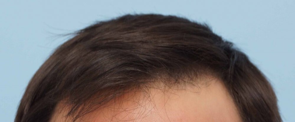 Dr Farjo hair transplant7.jpg