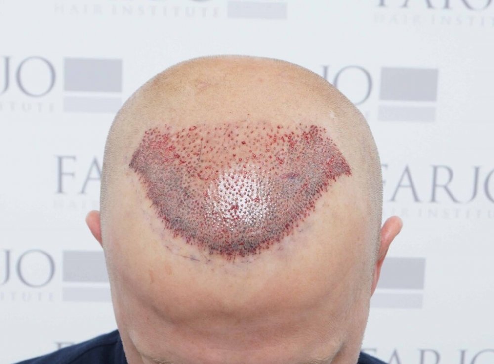 Dr Farjo Hair Transplant7.jpg