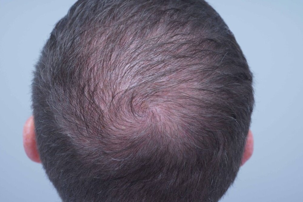 Dr Farjo hair transplant7.jpg