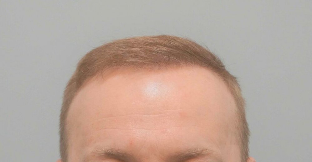 Dr Farjo Hair Transplant8.jpg