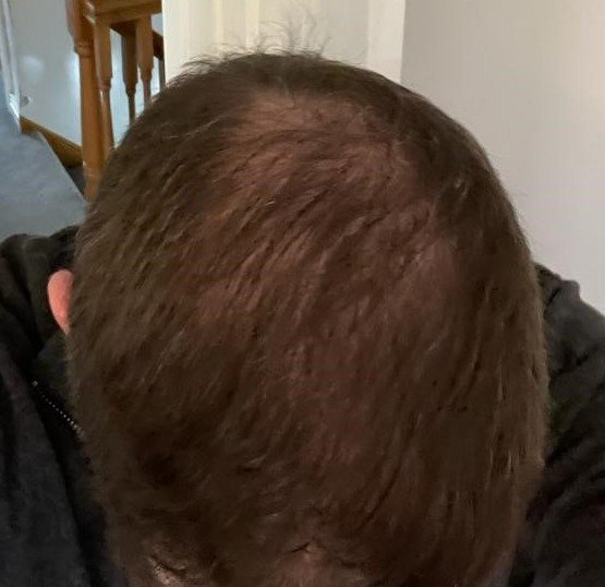 Dr Farjo hair transplant8.jpg