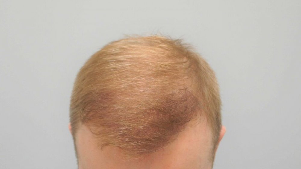 Dr Farjo Hair Transplant9.jpg
