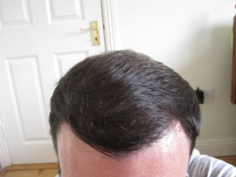 Dr Feller hair transplant result 1.jpg