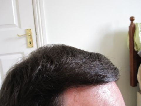 Dr Feller hair transplant result 2.jpg