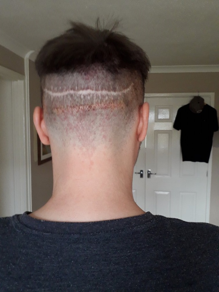 Dr. Feller Strip Scar.jpg