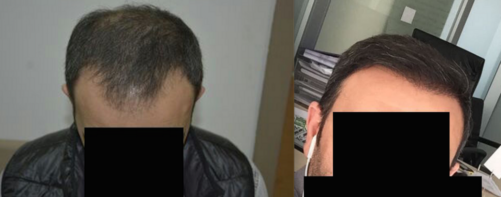 DR HAKAN DOGANAY FUE HAIR TRANSPLANT1.png