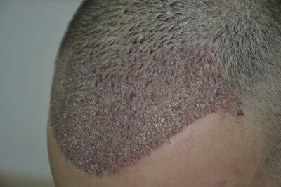 DR HAKAN DOGANAY FUE HAIR TRANSPLANT10.jpg