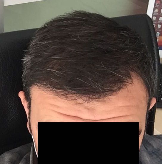 DR HAKAN DOGANAY FUE HAIR TRANSPLANT11.jpg