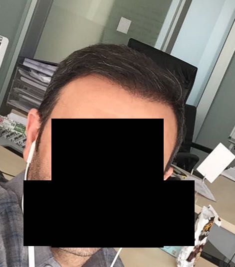 DR HAKAN DOGANAY FUE HAIR TRANSPLANT12.jpg