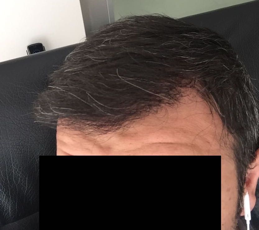 DR HAKAN DOGANAY FUE HAIR TRANSPLANT13.jpg