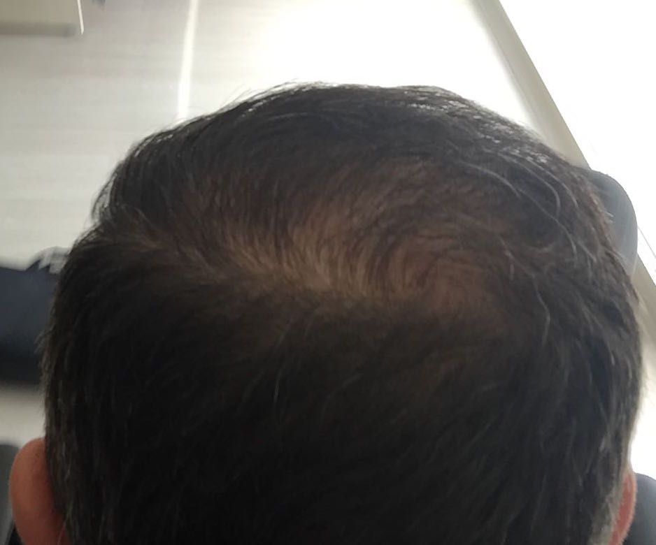 DR HAKAN DOGANAY FUE HAIR TRANSPLANT14.jpg