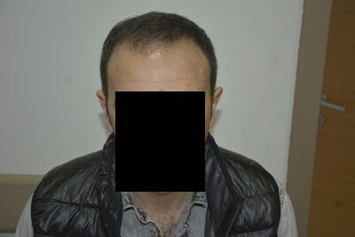 DR HAKAN DOGANAY FUE HAIR TRANSPLANT2.jpg