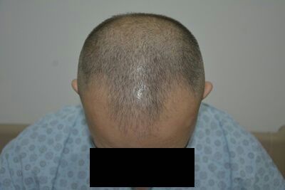 DR HAKAN DOGANAY FUE HAIR TRANSPLANT3.jpg