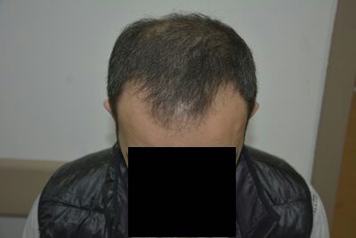 DR HAKAN DOGANAY FUE HAIR TRANSPLANT4.jpg