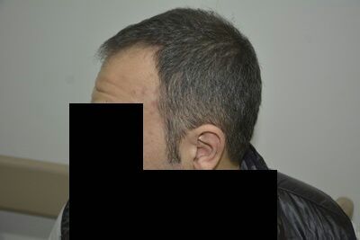 DR HAKAN DOGANAY FUE HAIR TRANSPLANT5.jpg
