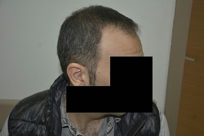 DR HAKAN DOGANAY FUE HAIR TRANSPLANT6.jpg