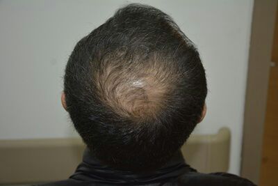 DR HAKAN DOGANAY FUE HAIR TRANSPLANT7.jpg